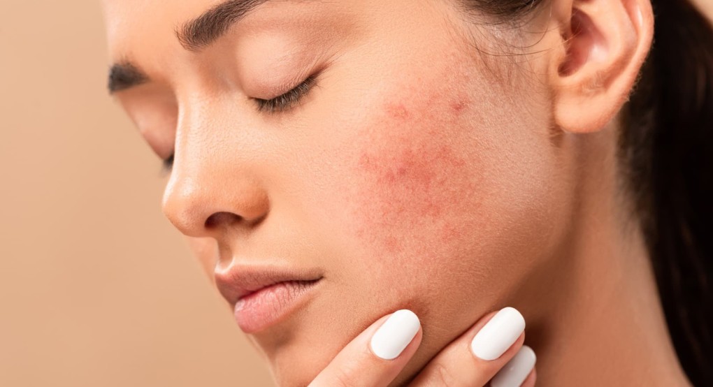 Acne Positivity Day: Η ακμή δεν επηρεάζει μόνο το δέρμα μας