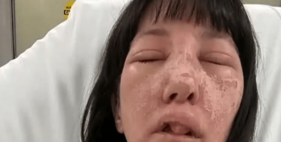 Γεωργία: Γυναίκα δέχθηκε επίθεση από δηλητηριώδεις αράχνες και παραμορφώθηκε το πρόσωπό της – Σοκαριστικές εικόνες