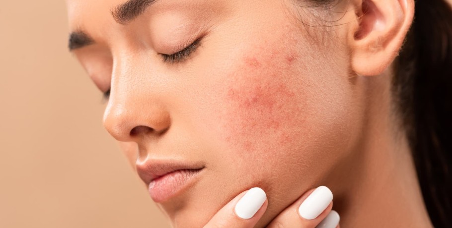 Acne Positivity Day: Η ακμή δεν επηρεάζει μόνο το δέρμα μας